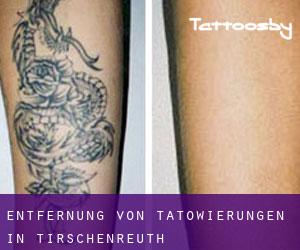 Entfernung von Tätowierungen in Tirschenreuth