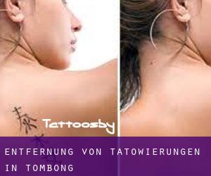 Entfernung von Tätowierungen in Tombong