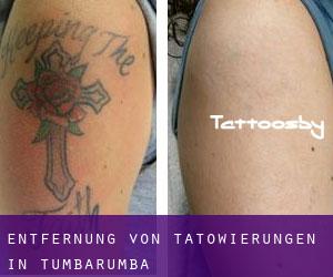 Entfernung von Tätowierungen in Tumbarumba