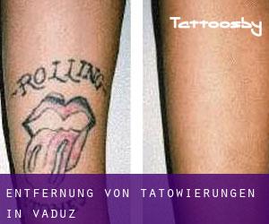 Entfernung von Tätowierungen in Vaduz