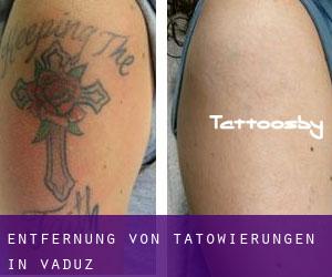 Entfernung von Tätowierungen in Vaduz