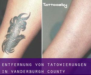 Entfernung von Tätowierungen in Vanderburgh County