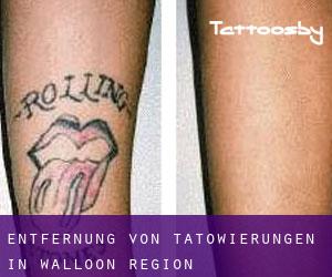 Entfernung von Tätowierungen in Walloon Region