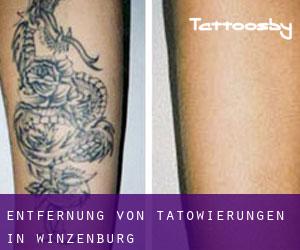 Entfernung von Tätowierungen in Winzenburg